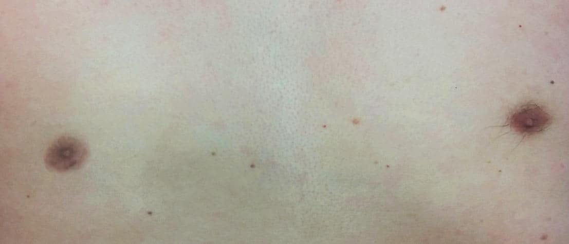 maennliche Warze nachher pigmentierung