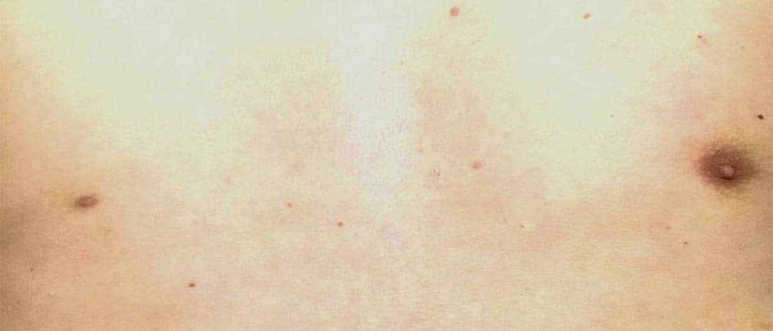 maennliche-Warze-vorher-pigmentierung