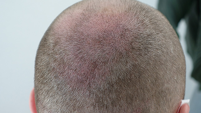 haarpigmentierung nachher