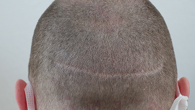 transplantationsnarbe vorher