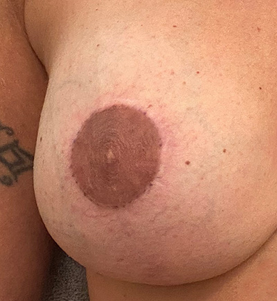 brust op narbe beperfect