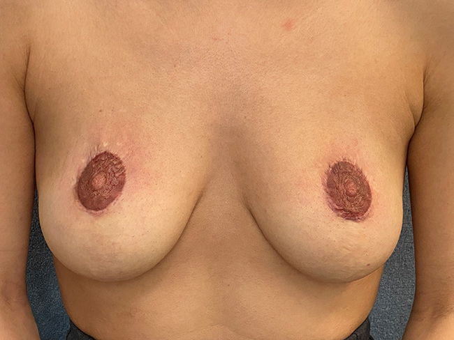 brust op narbe nachher-beperfect