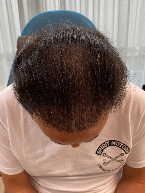 haarverdichtung nachher