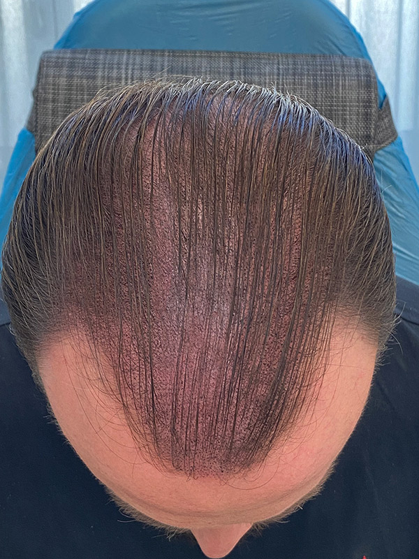 kopfhaut pigmentiereung