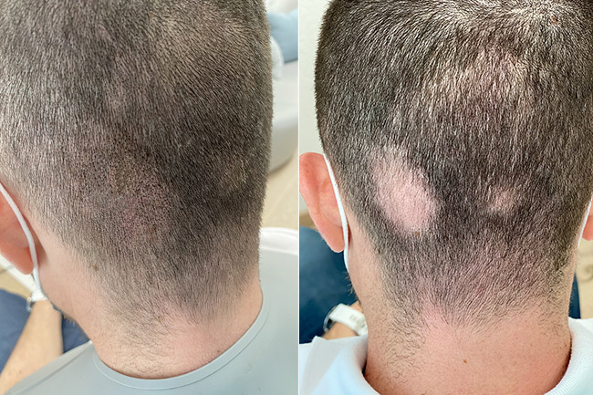 kreisrunder haarausfall pigmentation beperfect