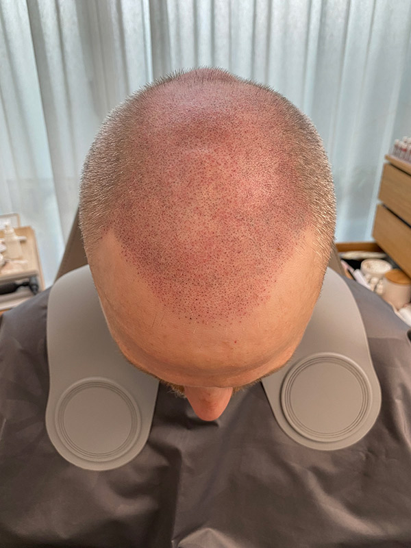 smp nach pigmentierung