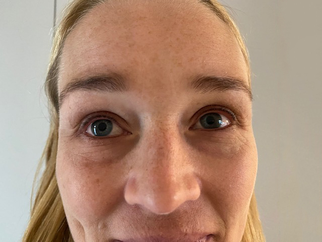 augenlider pigmentierung nachher