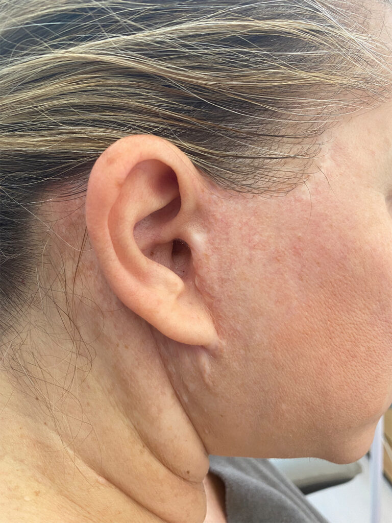 facelift narbe nachher