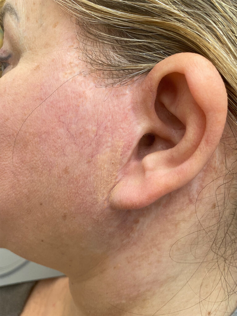 facelift narbe pigmentierung