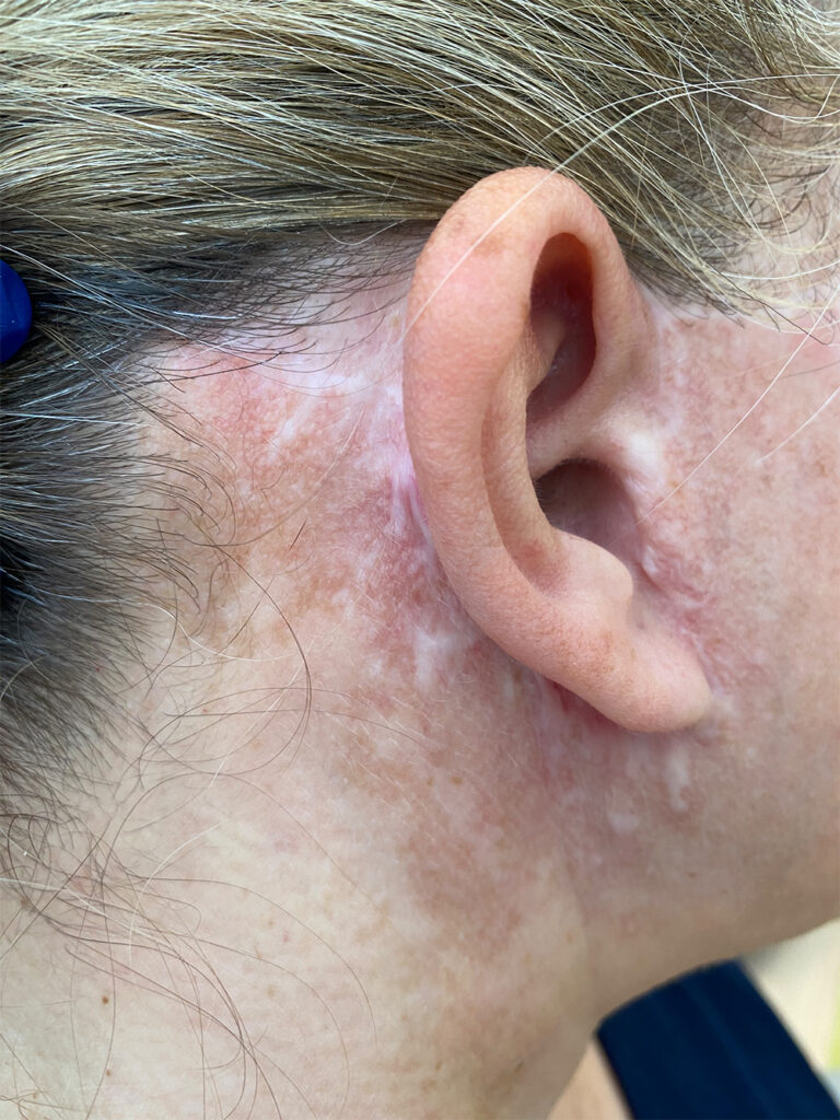 faclift narbe vorher