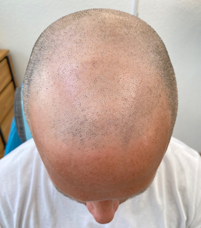 haare tätowieren, gesamter oberkopf vor der behandlung