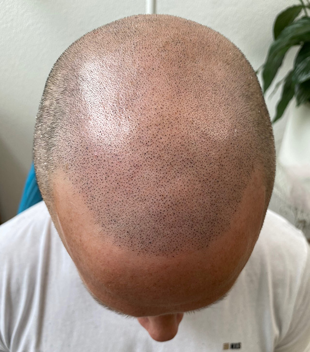micropigmentation nach der ersten behandlung
