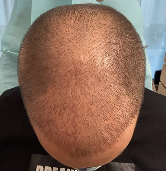 haartransplantation vs smp