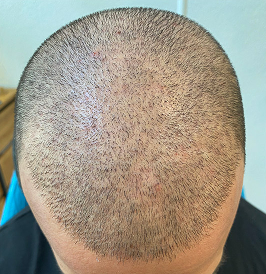 kopfhautpigmentierung nach haartransplantation
