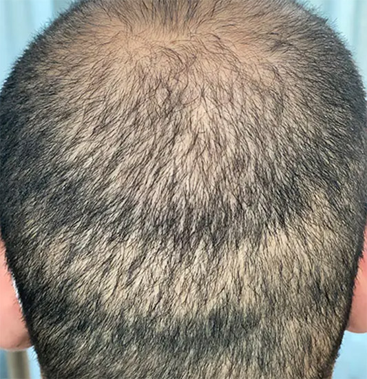 SMP vs Haartransplantation