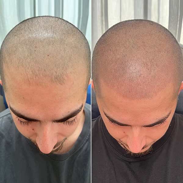 Haarpigmentierung beperfect brermgarten