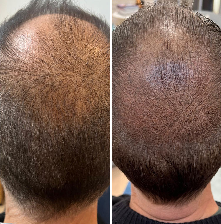 Diffuser Haarausfall Verdichtung beperfect