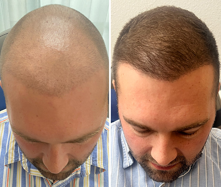 Haarwachstum nach Smp Haarvitalisierung beperfect