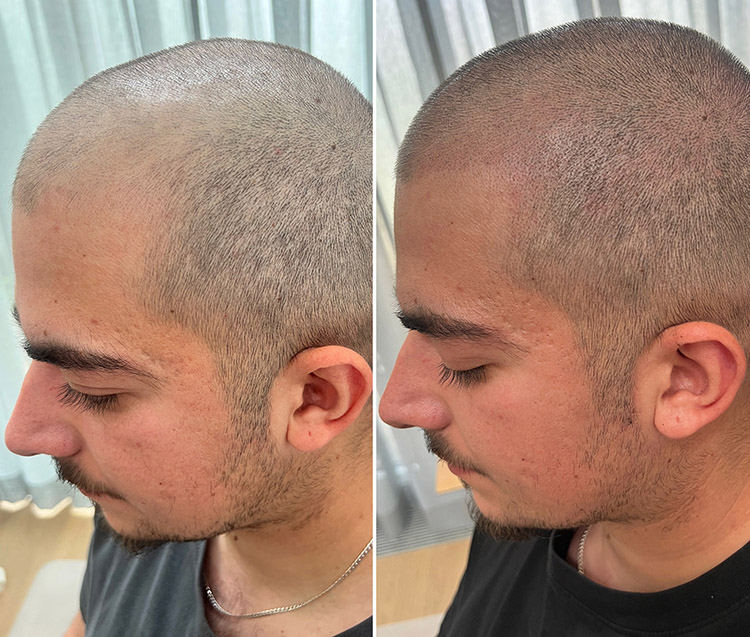 Geheimratsecke Micropigmentation von beperfect