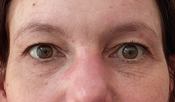 Augenbrauen Pigmentierung vorher